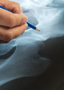 Hip X-ray
